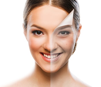 skin peel treatment